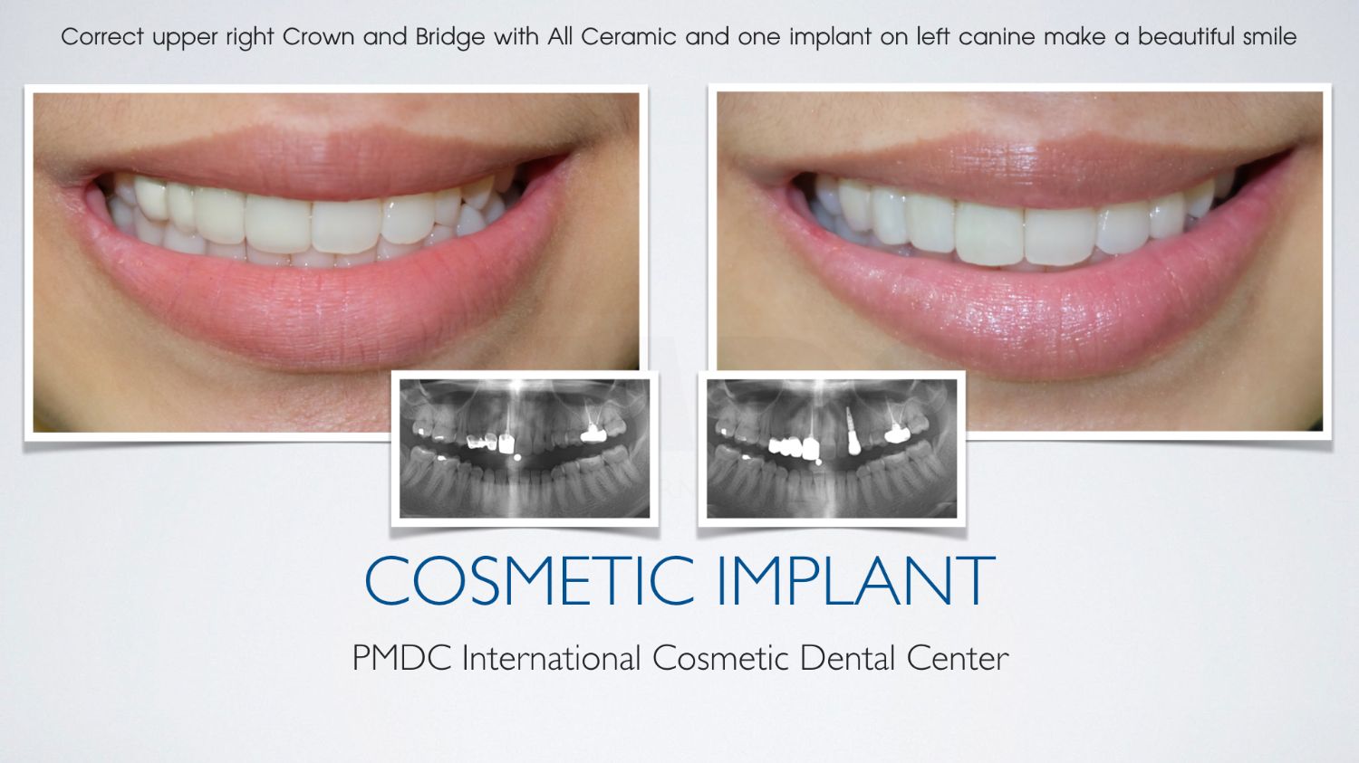 Cosmetic Implant